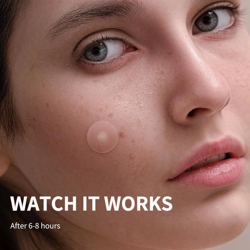 720 PCS Acne Patches Hydrocolloid Round 360/540 PCS Acne Patches !